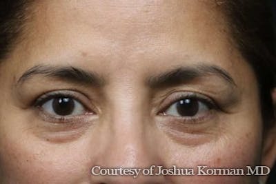 Eyelid Before & After Gallery - Patient 373958 - Image 2