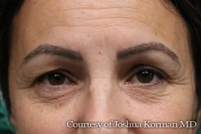 Eyelid Before & After Gallery - Patient 364600 - Image 1
