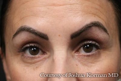 Eyelid Before & After Gallery - Patient 364600 - Image 2