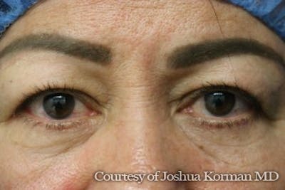 Eyelid Before & After Gallery - Patient 125453 - Image 1