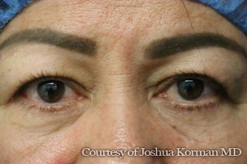 Eyelid Before & After Gallery - Patient 125453 - Image 1
