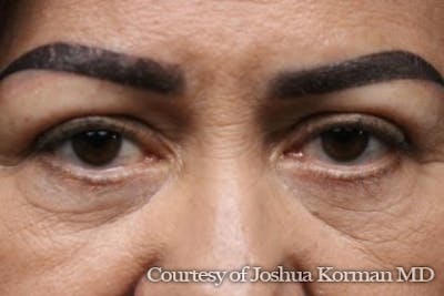 Eyelid Before & After Gallery - Patient 125453 - Image 2