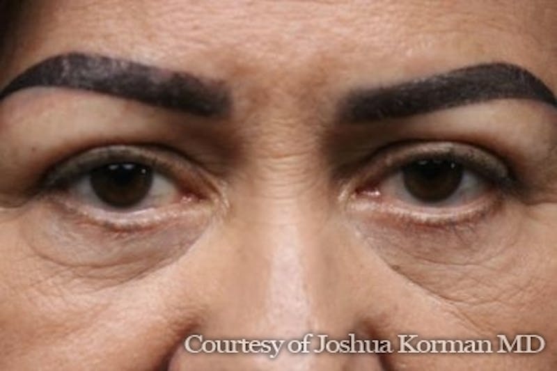 Eyelid Before & After Gallery - Patient 125453 - Image 2
