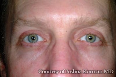 Eyelid Before & After Gallery - Patient 125726 - Image 2