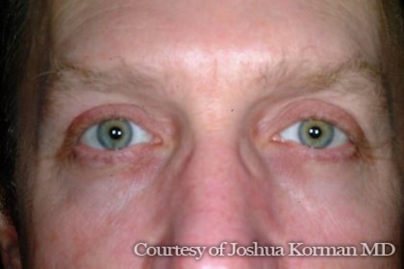 Eyelid Before & After Gallery - Patient 125726 - Image 2