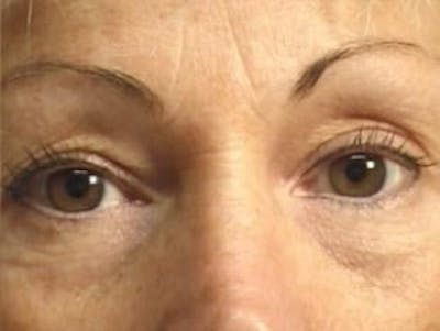 Eyelid Before & After Gallery - Patient 302199 - Image 1