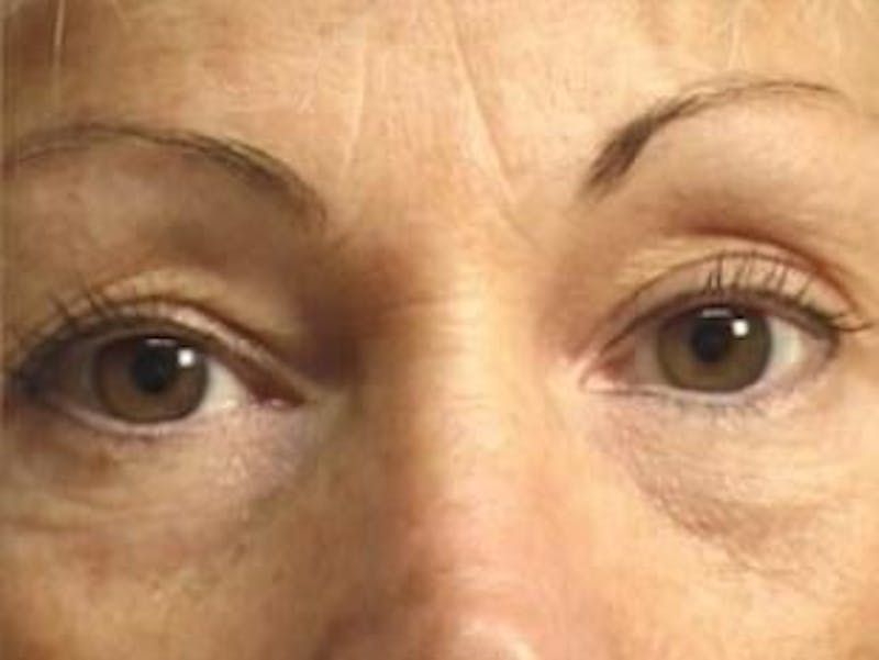 Eyelid Before & After Gallery - Patient 302199 - Image 1