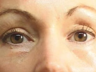 Eyelid Before & After Gallery - Patient 302199 - Image 2