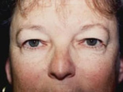 Eyelid Before & After Gallery - Patient 309926 - Image 1