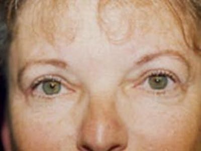 Eyelid Before & After Gallery - Patient 309926 - Image 2