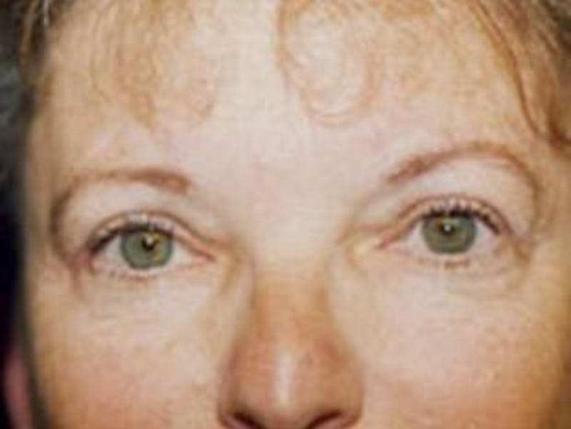 Eyelid Before & After Gallery - Patient 309926 - Image 2