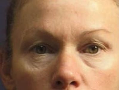Eyelid Before & After Gallery - Patient 316934 - Image 1