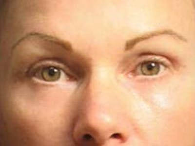 Eyelid Before & After Gallery - Patient 316934 - Image 2