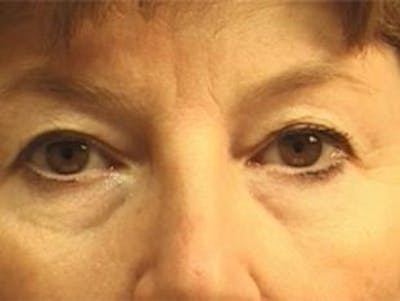 Eyelid Before & After Gallery - Patient 371401 - Image 1