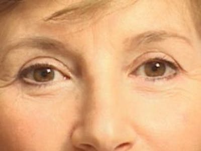 Eyelid Before & After Gallery - Patient 371401 - Image 2