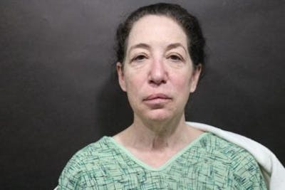 Facelift Before & After Gallery - Patient 233130 - Image 1