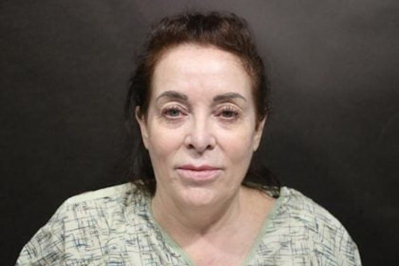 Facelift Before & After Gallery - Patient 163254 - Image 3