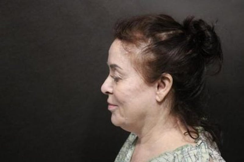 Facelift Before & After Gallery - Patient 163254 - Image 5