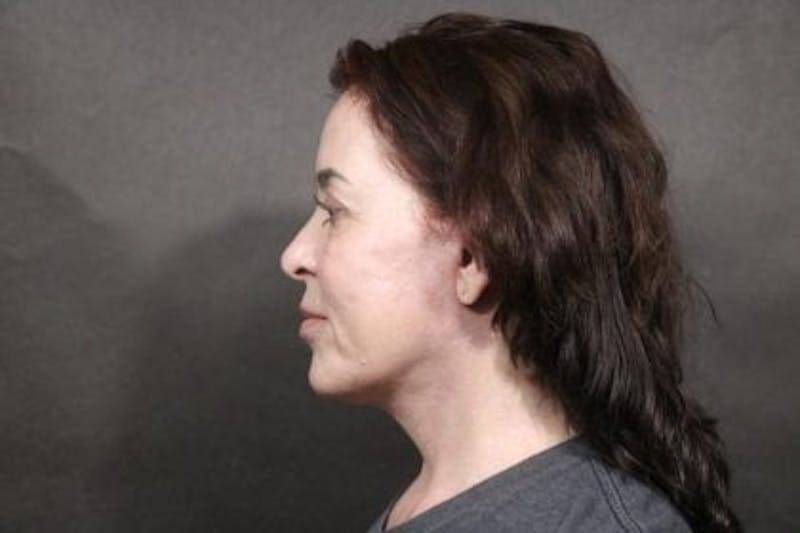 Facelift Before & After Gallery - Patient 163254 - Image 6