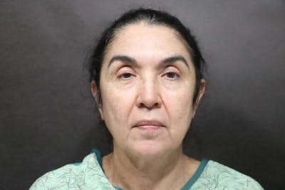 Facelift Before & After Gallery - Patient 121210 - Image 1