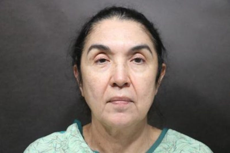 Facelift Before & After Gallery - Patient 215297 - Image 3