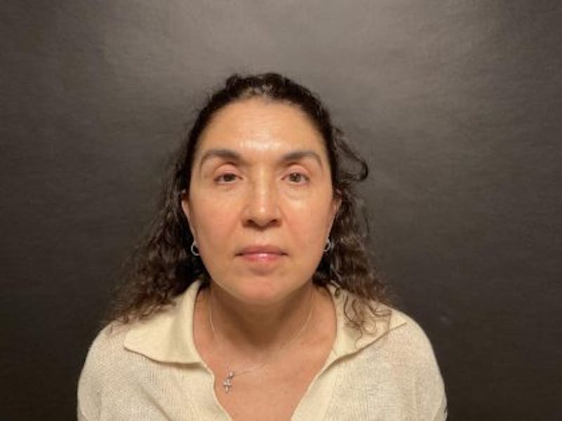 Facelift Before & After Gallery - Patient 215297 - Image 4