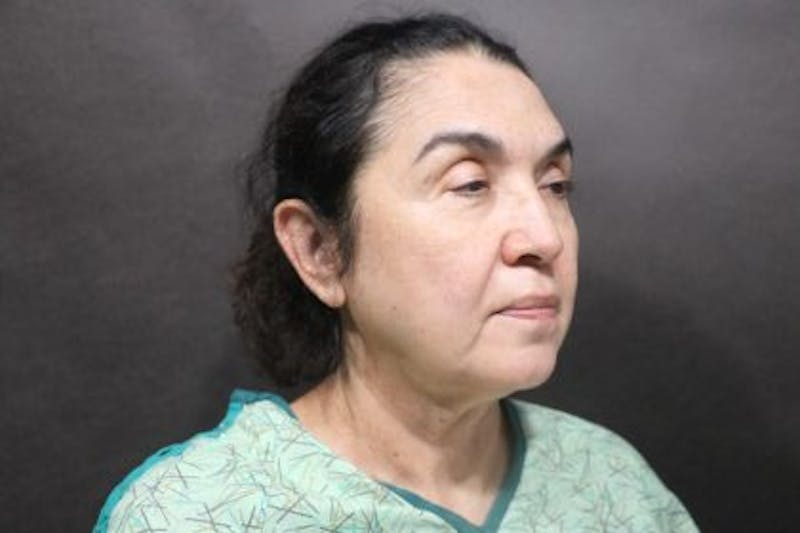 Facelift Before & After Gallery - Patient 215297 - Image 5