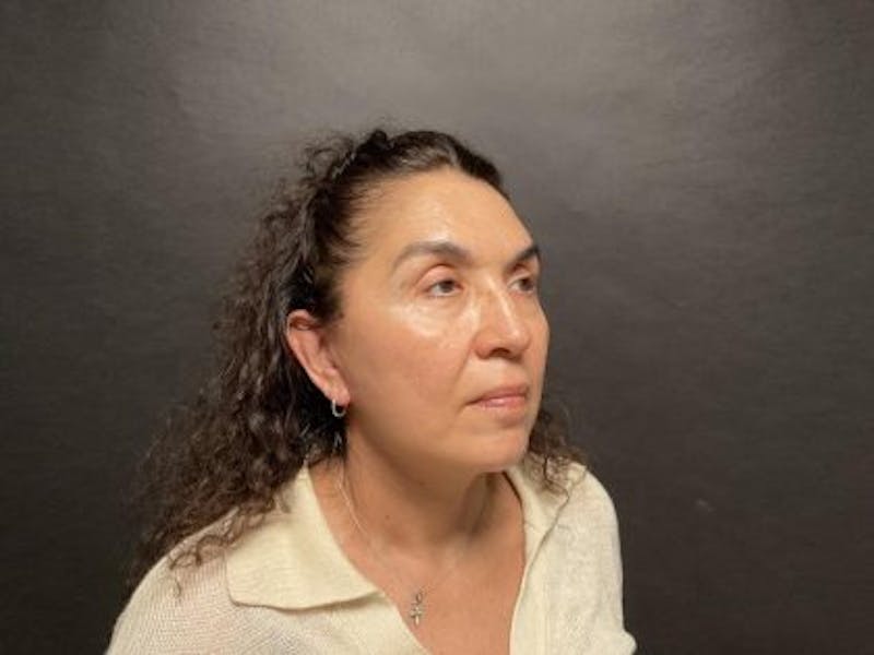 Facelift Before & After Gallery - Patient 215297 - Image 6