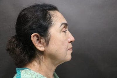 Facelift Before & After Gallery - Patient 215297 - Image 1