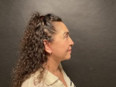 Facelift Before & After Gallery - Patient 215297 - Image 2
