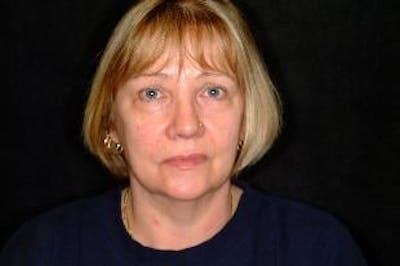Facelift Before & After Gallery - Patient 276114 - Image 1