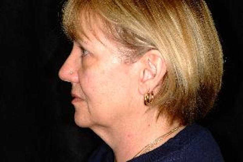 Facelift Before & After Gallery - Patient 276114 - Image 3
