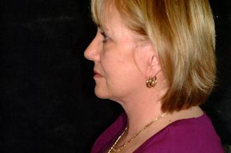 Facelift Before & After Gallery - Patient 276114 - Image 4