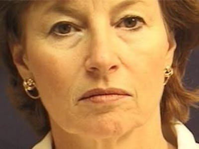 Facelift Before & After Gallery - Patient 326003 - Image 1
