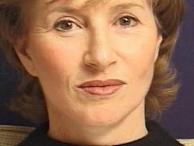 Facelift Before & After Gallery - Patient 326003 - Image 2