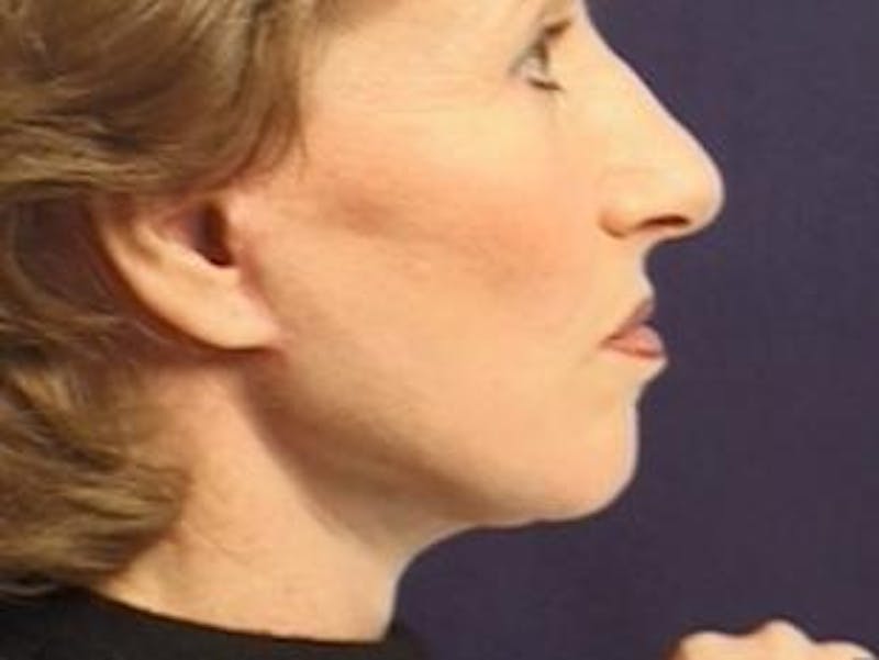 Facelift Before & After Gallery - Patient 326003 - Image 4