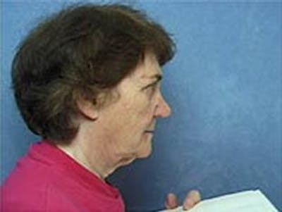Facelift Before & After Gallery - Patient 912701 - Image 1