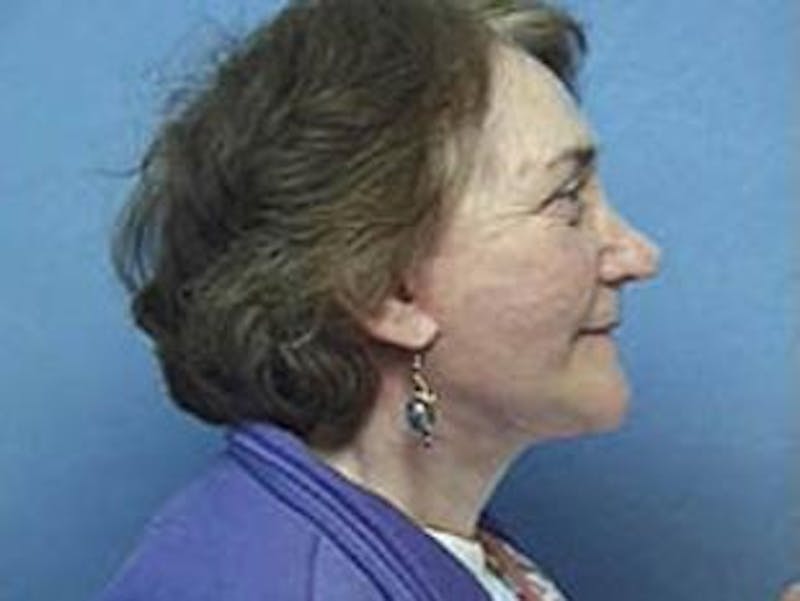 Facelift Before & After Gallery - Patient 912701 - Image 2