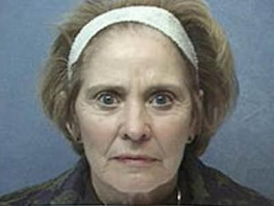 Facelift Before & After Gallery - Patient 152029 - Image 1