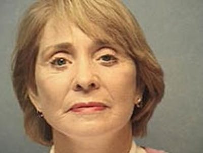 Facelift Before & After Gallery - Patient 152029 - Image 2