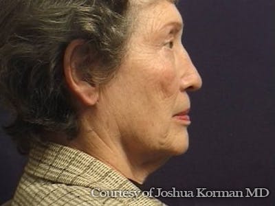 Facelift Before & After Gallery - Patient 357715 - Image 1