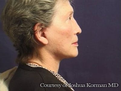 Facelift Before & After Gallery - Patient 357715 - Image 2