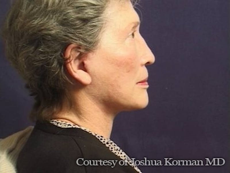 Facelift Before & After Gallery - Patient 357715 - Image 2