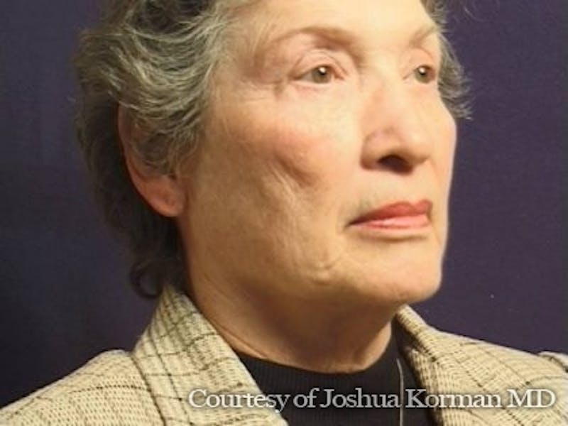 Facelift Before & After Gallery - Patient 357715 - Image 3