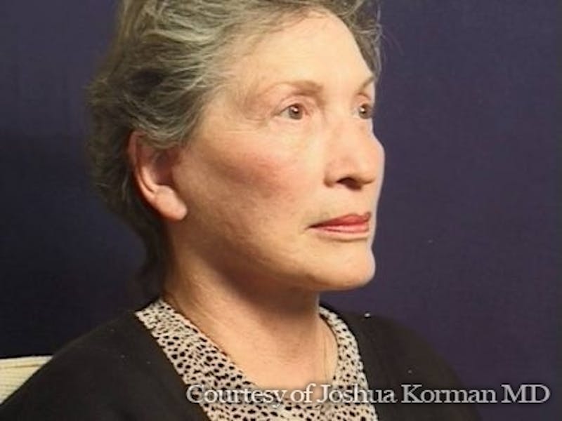 Facelift Before & After Gallery - Patient 357715 - Image 4
