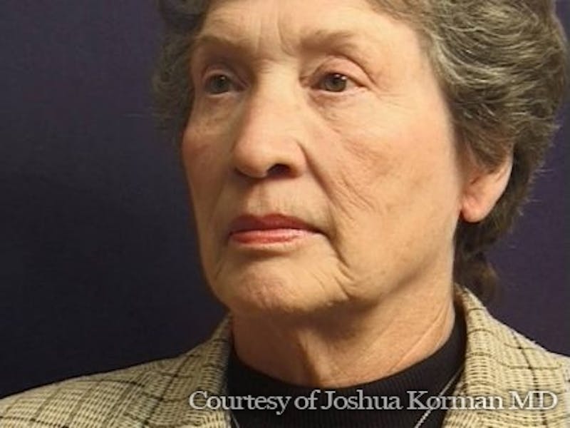 Facelift Before & After Gallery - Patient 357715 - Image 5
