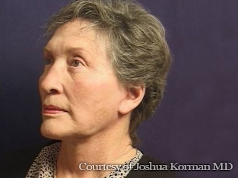 Facelift Before & After Gallery - Patient 357715 - Image 6