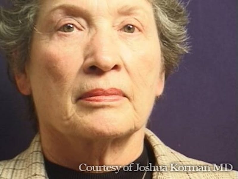 Facelift Before & After Gallery - Patient 357715 - Image 7
