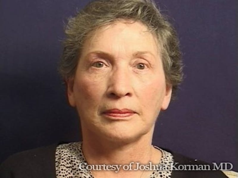 Facelift Before & After Gallery - Patient 357715 - Image 8
