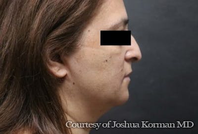 Rhinoplasty Before & After Gallery - Patient 277510 - Image 1